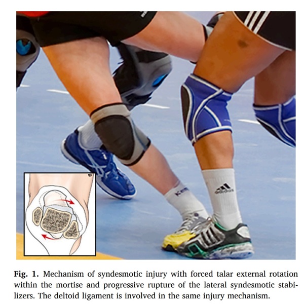 Diagnosing instability of ligamentous syndesmotic injuries: A ...